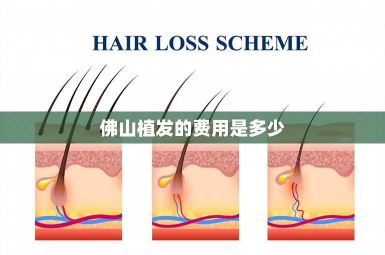 佛山植发的费用是多少