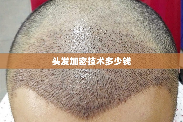 头发加密技术多少钱
