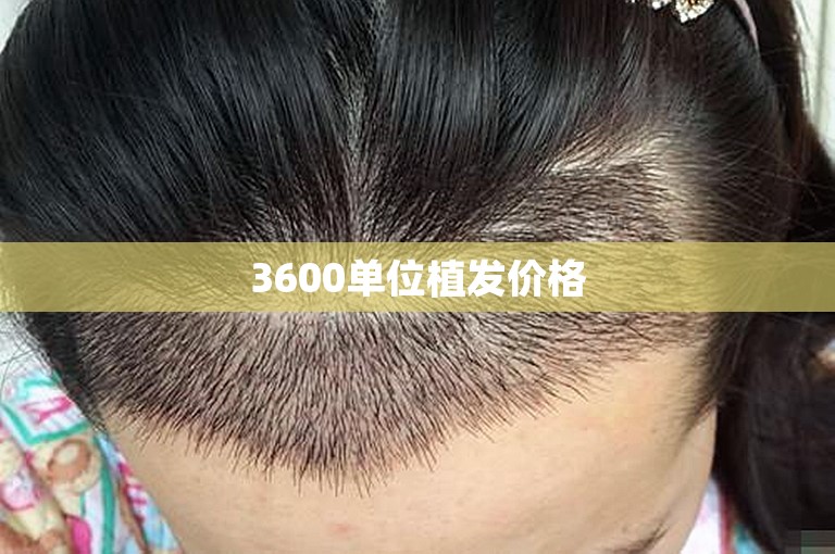 3600单位植发价格
