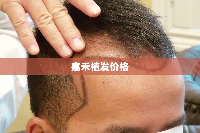 嘉禾植发价格