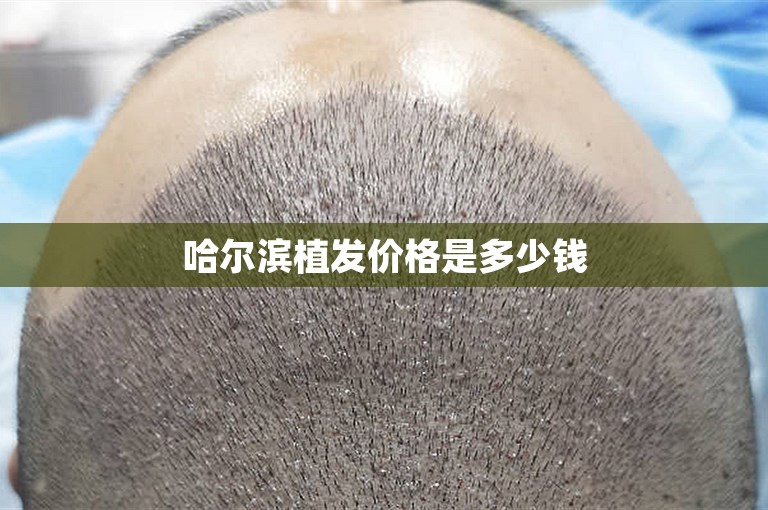 哈尔滨植发价格是多少钱