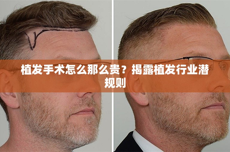 植发手术怎么那么贵？揭露植发行业潜规则