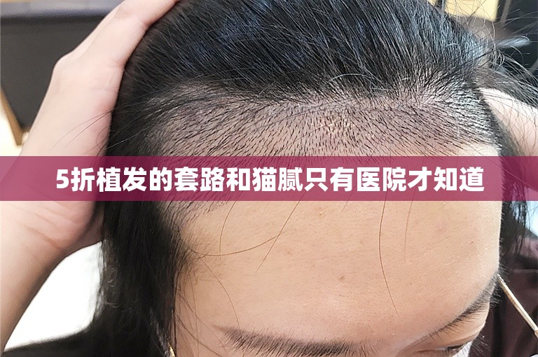 5折植发的套路和猫腻只有医院才知道 5折植发的套路和猫腻只有医院才知道