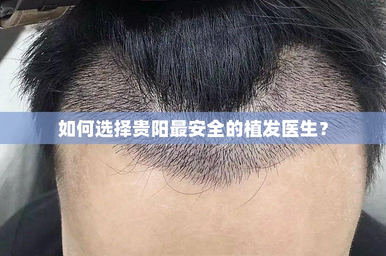 如何选择贵阳最安全的植发医生？