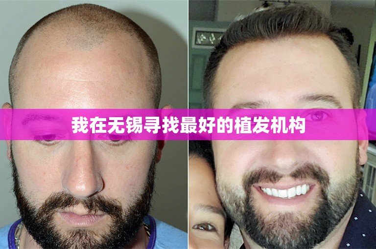 我在无锡寻找最好的植发机构