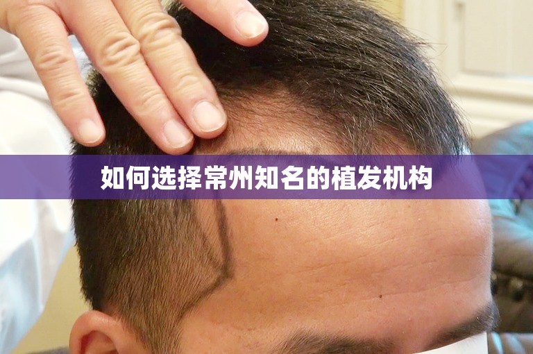 如何选择常州知名的植发机构