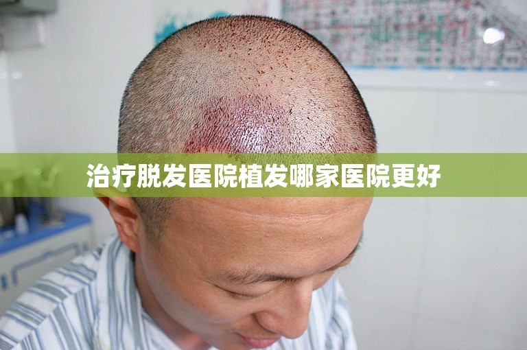 治疗脱发医院植发哪家医院更好