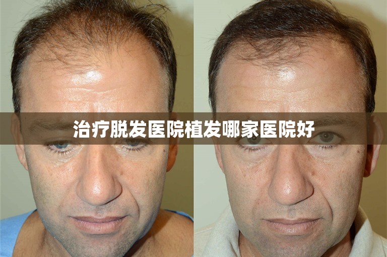 治疗脱发医院植发哪家医院好