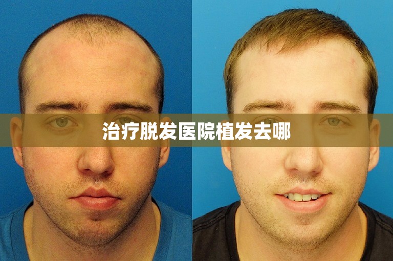 治疗脱发医院植发去哪