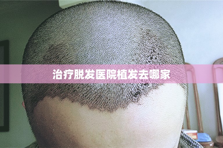 治疗脱发医院植发去哪家