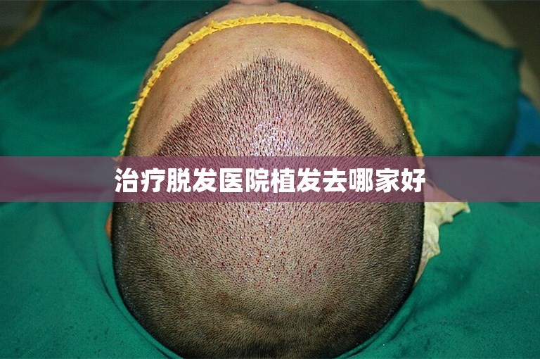 治疗脱发医院植发去哪家好