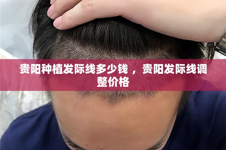 贵阳种植发际线多少钱 ，贵阳发际线调整价格