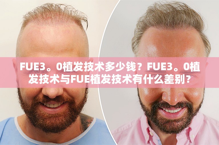 FUE3。0植发技术多少钱？FUE3。0植发技术与FUE植发技术有什么差别？