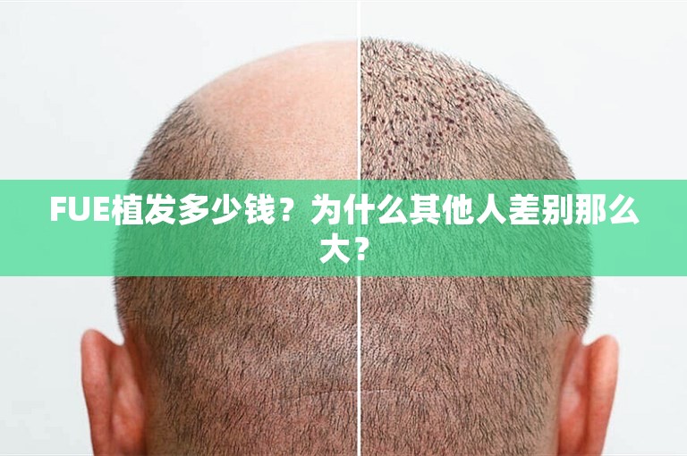 FUE植发多少钱?为什么其他人差别那么大? FUE植发多少钱?为什么其他人差别那么大?