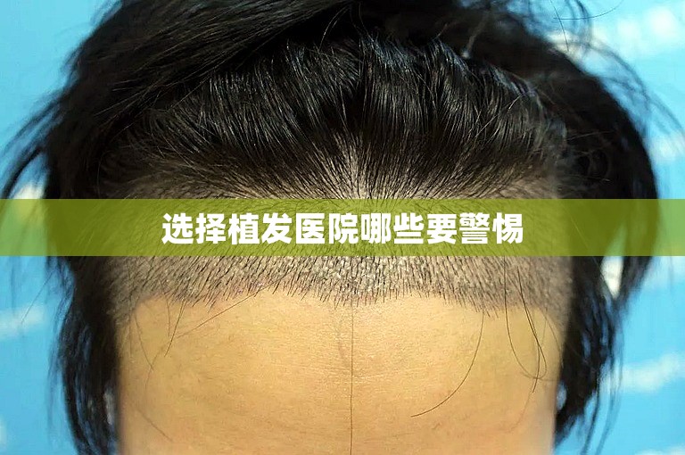 选择植发医院哪些要警惕