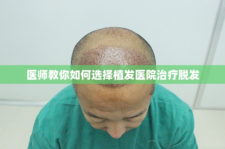 医师教你如何选择植发医院治疗脱发