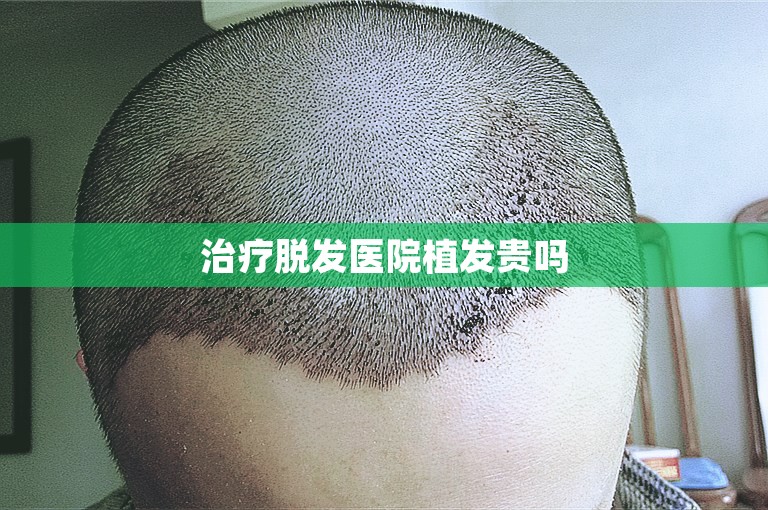 治疗脱发医院植发贵吗