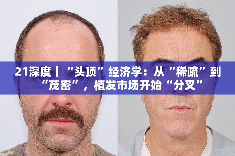 21深度｜“头顶”经济学：从“稀疏”到“茂密”，植发市场开始“分叉”