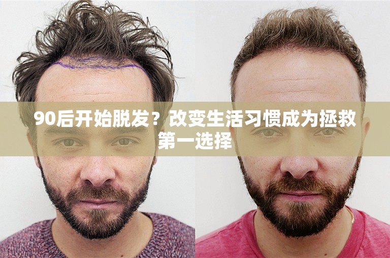90后开始脱发?改变生活习惯成为拯救第一选择 90后开始脱发?改变生活习惯成为拯救第一选择