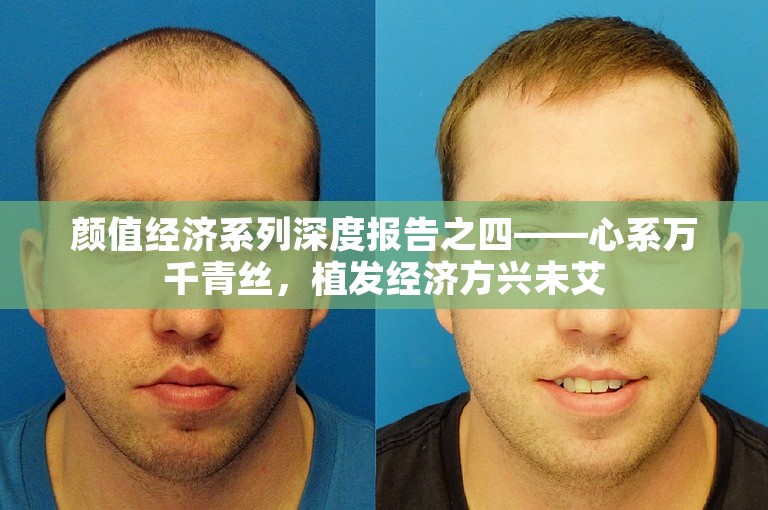 颜值经济系列深度报告之四——心系万千青丝，植发经济方兴未艾