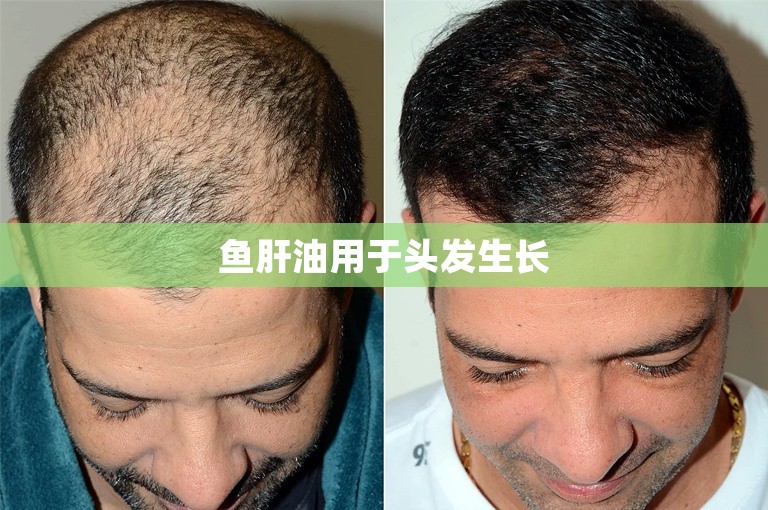 鱼肝油用于头发生长 鱼肝油用于头发生长