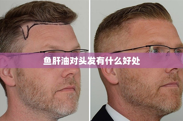 鱼肝油对头发有什么好处 鱼肝油对头发有什么好处