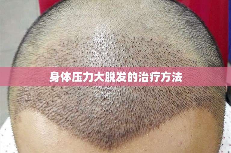 身体压力大脱发的治疗方法