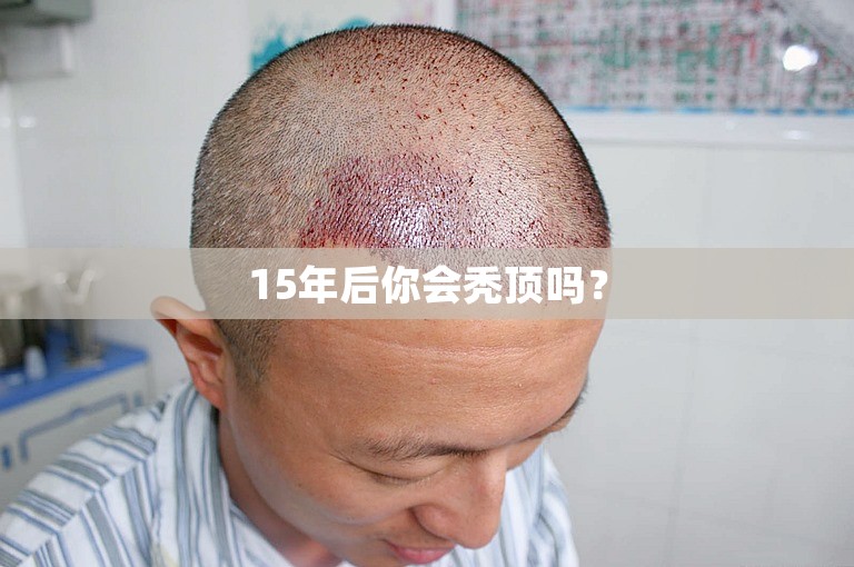 15年后你会秃顶吗？