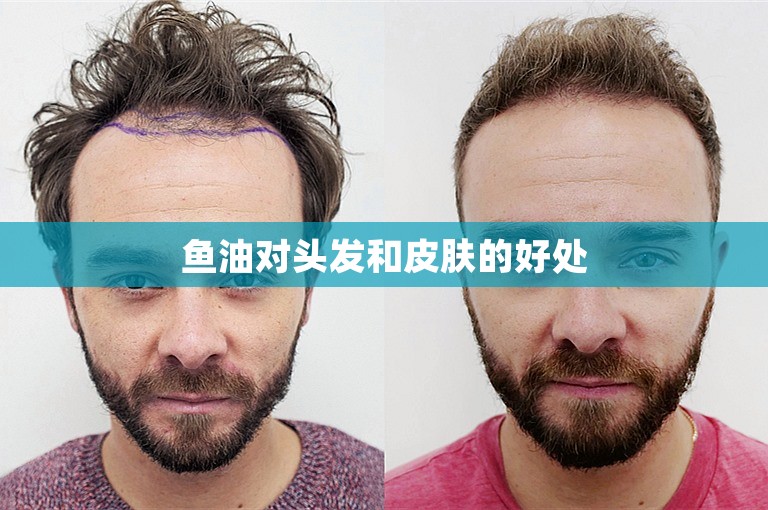 鱼油对头发和皮肤的好处 鱼油对头发和皮肤的好处