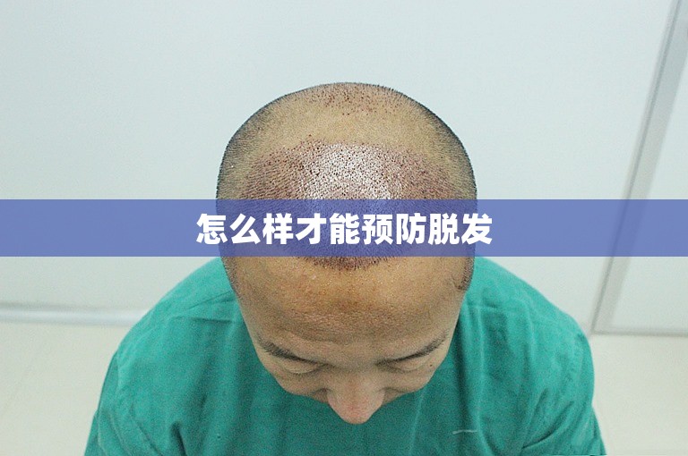 怎么样才能预防脱发