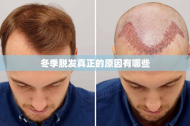 冬季脱发真正的原因有哪些