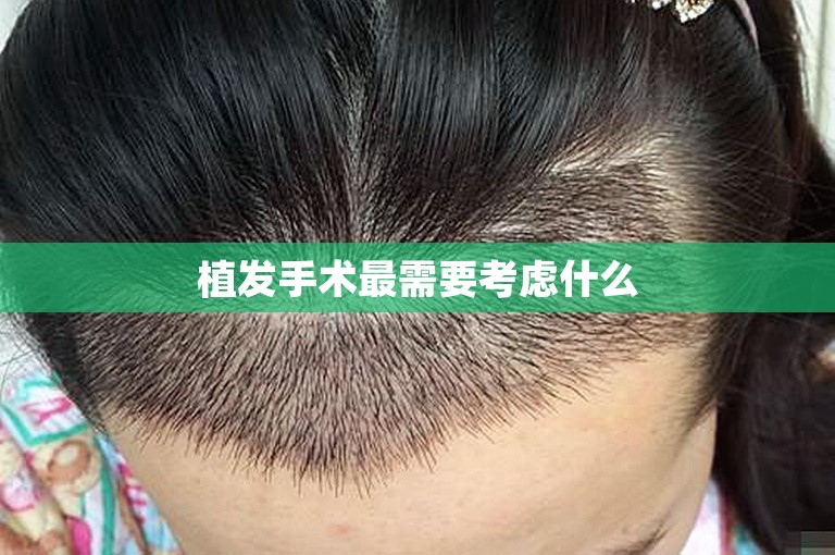 植发手术最需要考虑什么