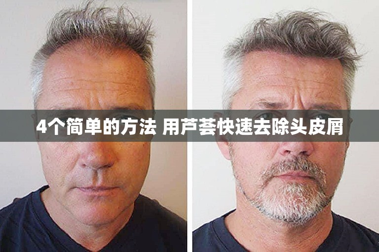 4个简单的方法 用芦荟快速去除头皮屑 4个简单的方法 用芦荟快速去除头皮屑