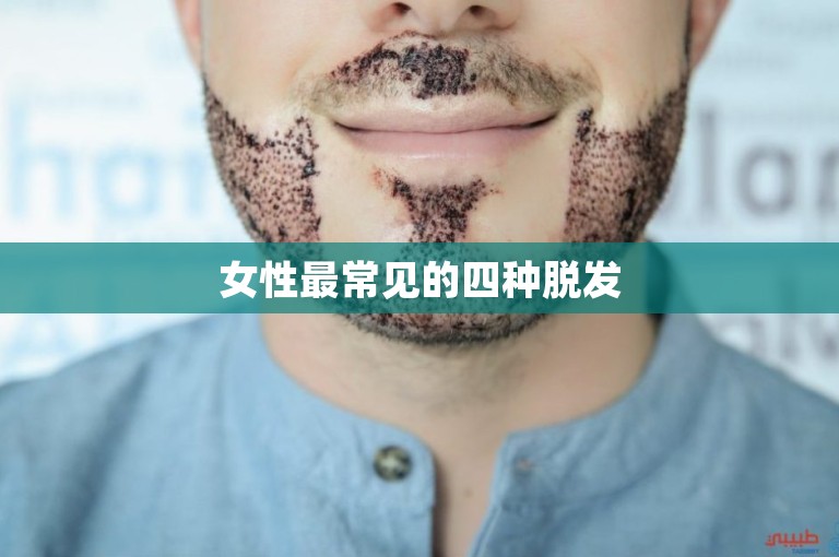 女性最常见的四种脱发