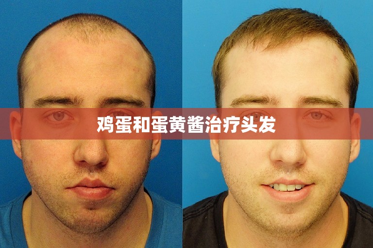 鸡蛋和蛋黄酱治疗头发 鸡蛋和蛋黄酱治疗头发
