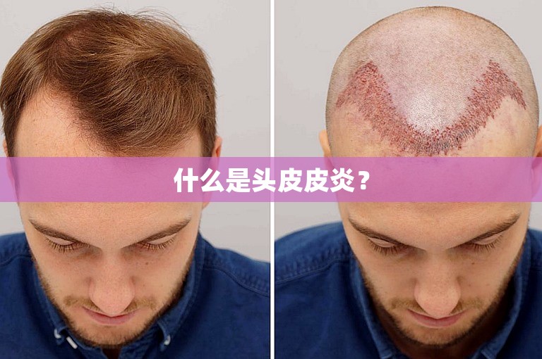 什么是头皮皮炎？