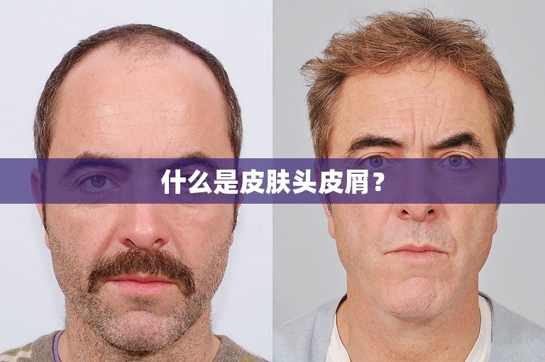 什么是皮肤头皮屑？