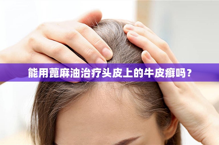 能用蓖麻油治疗头皮上的牛皮癣吗？