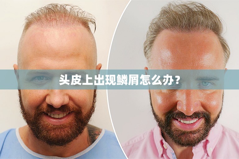头皮上出现鳞屑怎么办？
