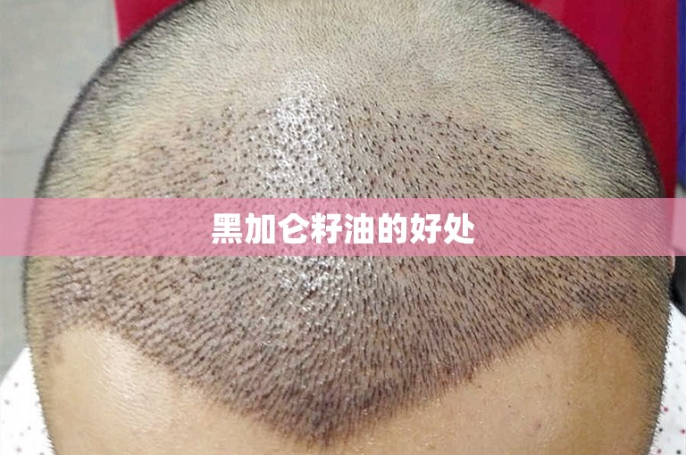 黑加仑籽油的好处 黑加仑籽油的好处