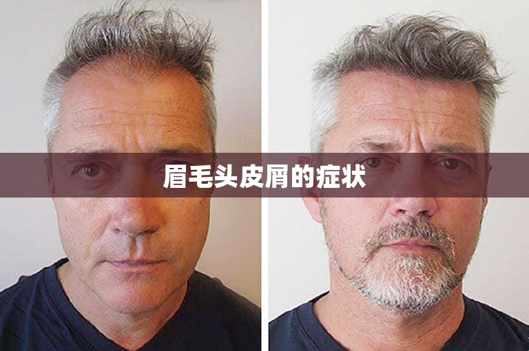 眉毛头皮屑的症状