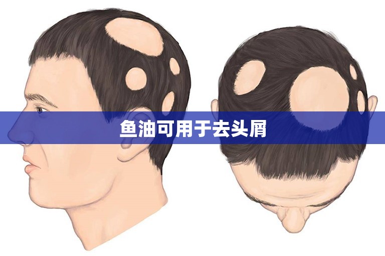 鱼油可用于去头屑 鱼油可用于去头屑