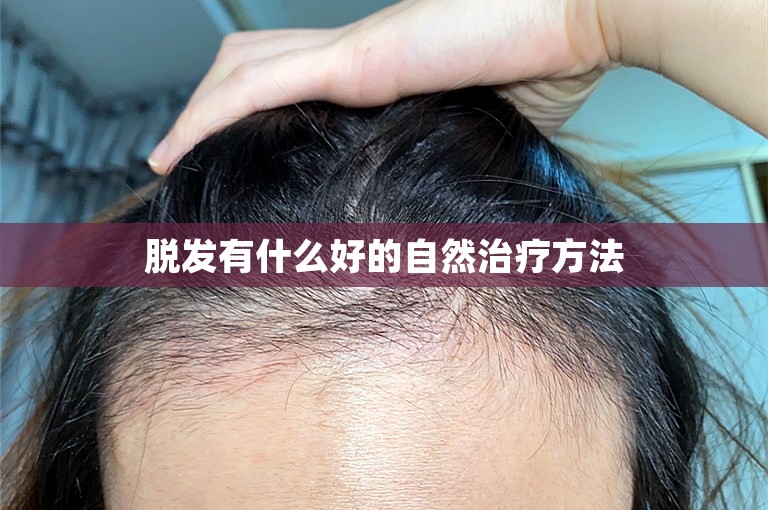 脱发有什么好的自然治疗方法