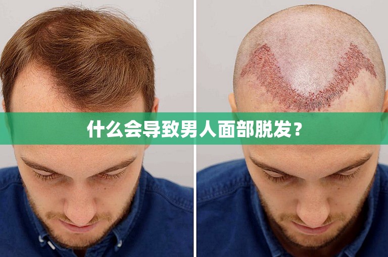 什么会导致男人面部脱发？