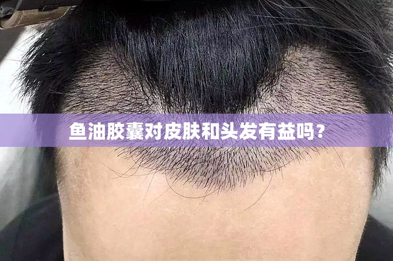 鱼油胶囊对皮肤和头发有益吗? 鱼油胶囊对皮肤和头发有益吗?