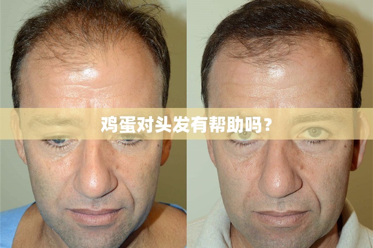 鸡蛋对头发有帮助吗？