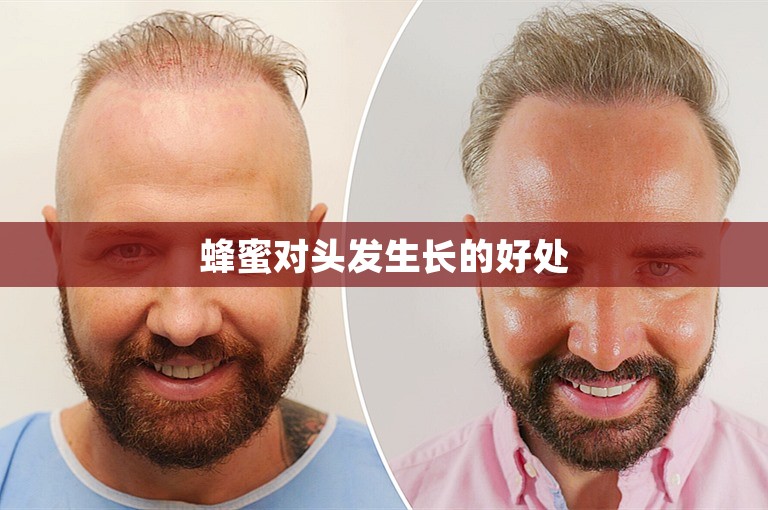蜂蜜对头发生长的好处 蜂蜜对头发生长的好处