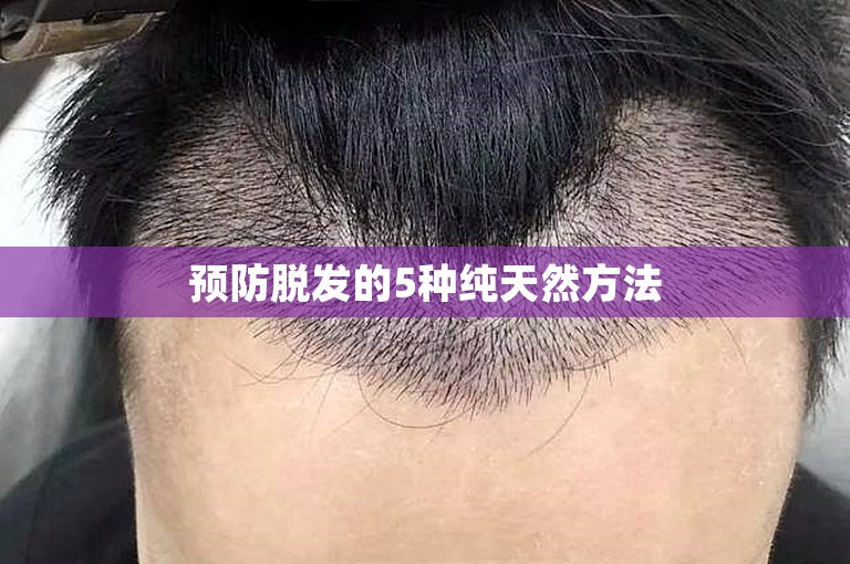 预防脱发的5种纯天然方法 预防脱发的5种纯天然方法
