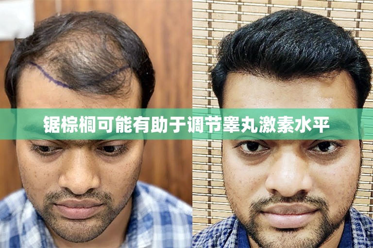 锯棕榈可能有助于调节睾丸激素水平