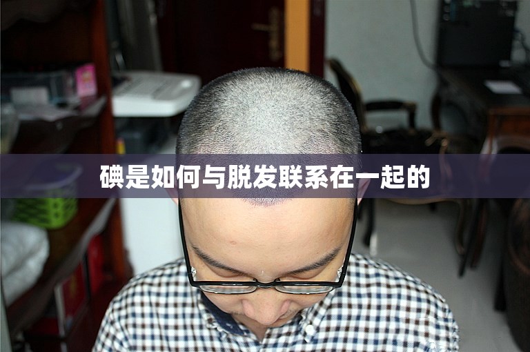 碘是如何与脱发联系在一起的